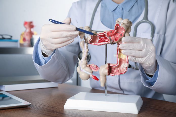 1999071686 featured image Doctor pointing at anatomical model of the colon